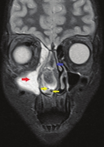 Coronal section, T2-weighted magnetic resonance image demonstrates a large, well-defined hyperintense mass in the right maxillary antrum (red arrow), displacement of the nasal septum (blue arrow) by the heterointense tumor mass to the left side and tiny flow voids are noted within the lesion consistent with hypervascularity (yellow arrows)
